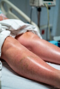 سپسیس (Sepsis) چیست؟ علائم، علت، درمان و پیشگیری